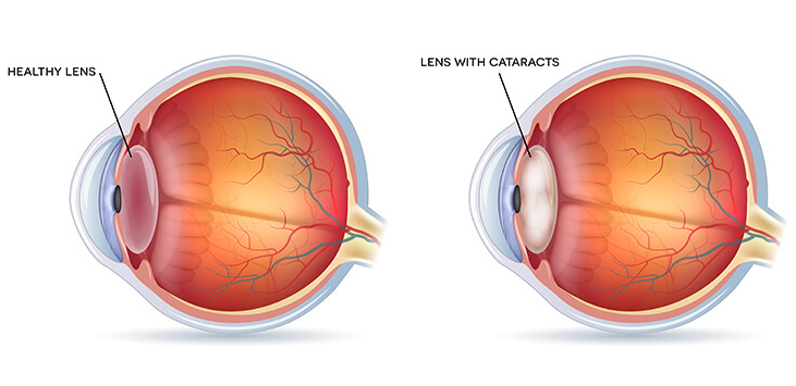 Cataract Diagram