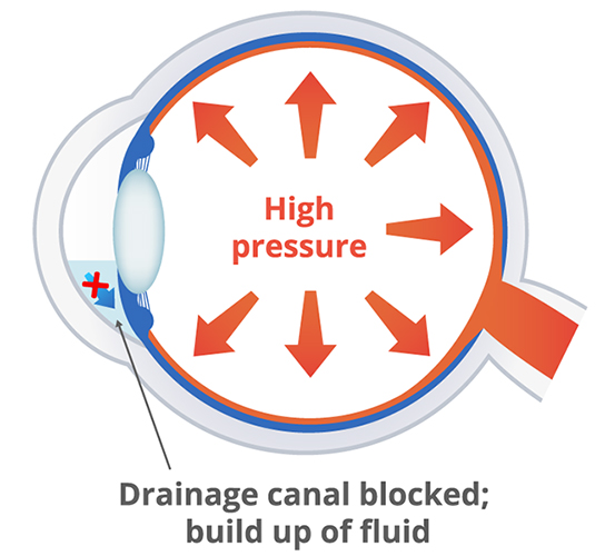 Glaucoma Diagram